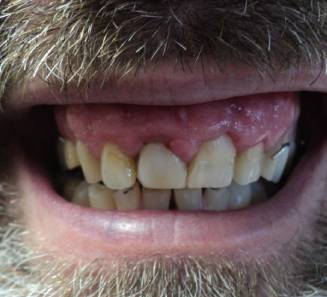 Teeth Before Smile Treatment