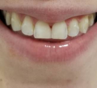 Smile Gallery After Treatment
