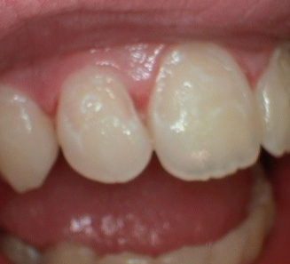 Smile Gallery Before Treatment